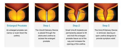 UroLift for BPH Miami | Enlarged Prostate Treatment South Florida