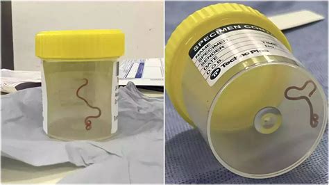 Physician Removed Live Worm From Australian Woman’s Brain - The Morning ...