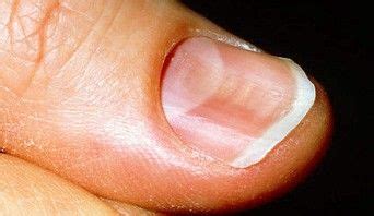 What Are Your Nails Telling You? | Fingernail health, Fingernail health ...