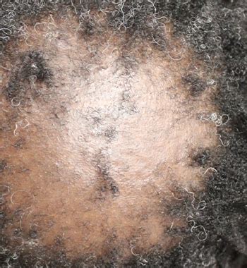 Central Centrifugal Cicatricial Alopecia - Richmond Dermatology