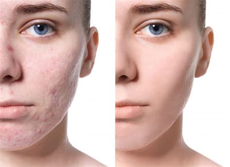 How Can I Get Rid of Acne Scars? | Lake Jackson ENT | Blog