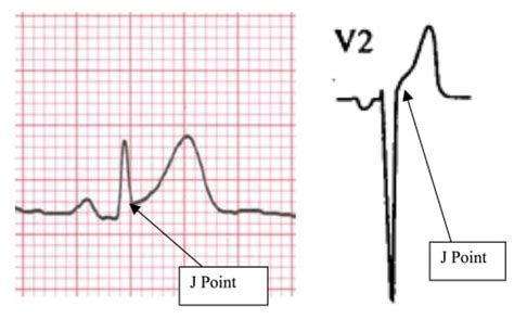 EKG Criteria for Fibrinolysis: What’s Up with the J Point? - The Western Journal of Emergency ...