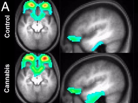 Brain on drugs scans - Business Insider