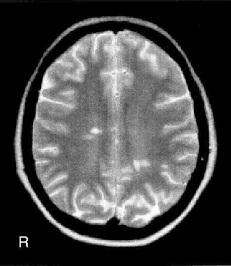 White matter hyperintensities on T2weighted brain MRI | Download ...