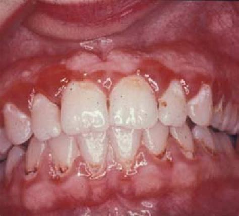 Red swollen gums of gingivitis. | Download Scientific Diagram