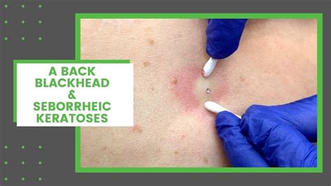 Blackhead On Back