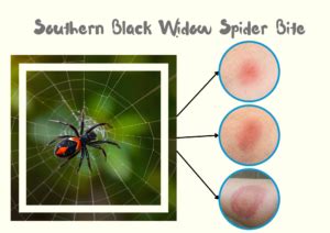 Black Widow Spider Bite Stages, Symptoms with Pictures (Identification)