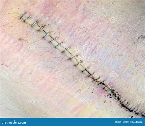 Staples Closing a Wound stock photo. Image of recovery - 269159874