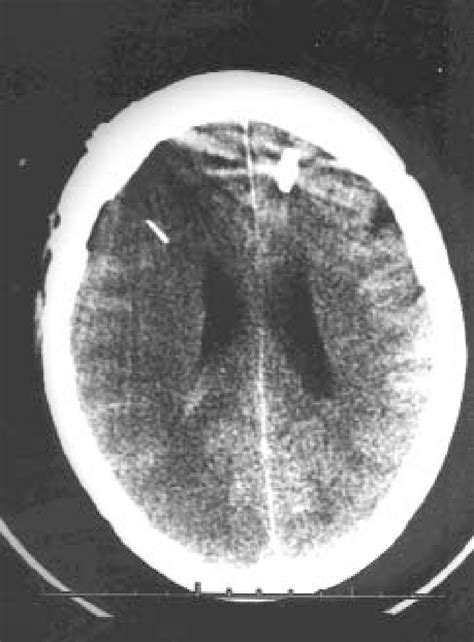 A computer tomography image demonstrating the position of a Licox ...