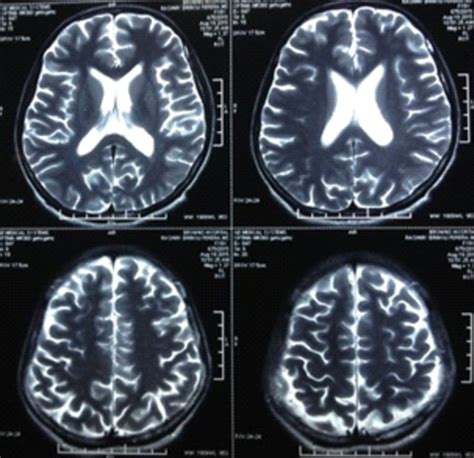 MRI brain showing diffuse cerebral atrophy. | Download Scientific Diagram