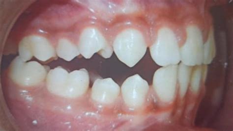 How to treat a Posterior Open Bite