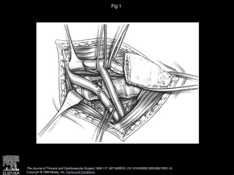 Subclavian artery involvement by apical chest tumors: A specific ...