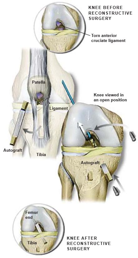 ACL Reconstruction | Central Coast Orthopedic Medical Group