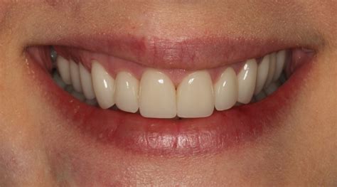 Before and After Porcelain Veneers & Full-Mouth Reconstruction & Dental Crowns Photos