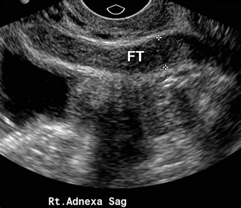 Essure Ultrasound