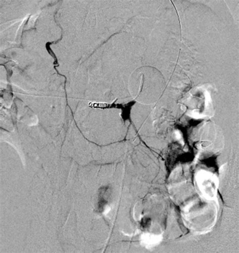 The Inadvertant Aortopexy • APPLIED RADIOLOGY