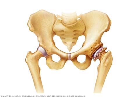 What Is Osteophyte? – Types, Causes, Symptoms, Treatment - Health | RXharun