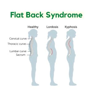 Flat Back Syndrome - Orchard Health Clinic - Osteopathy, Physiotherapy and Chiropractic