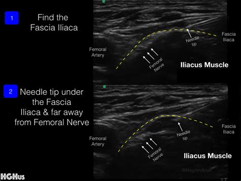 Femora Nerve Block — Highland EM Ultrasound Fueled pain management