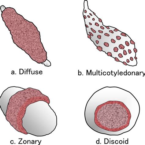 Classification by placental gross shape. | Download Scientific Diagram