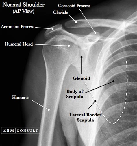 Anterior Shoulder Dislocation - General Review