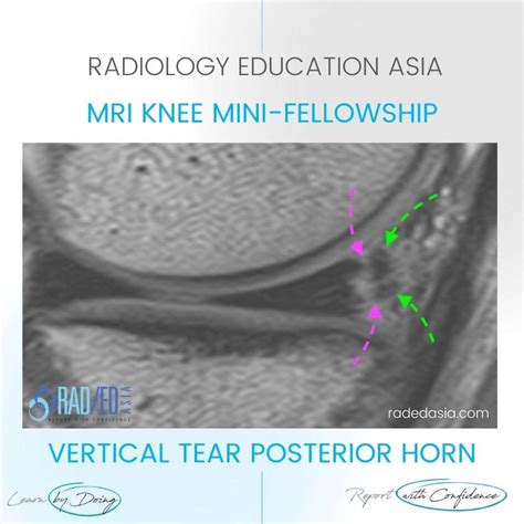 VERTICAL MENISCUS MENISCAL TEAR MRI KNEE - Radedasia