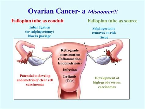 Prophylactic Salpingectomy