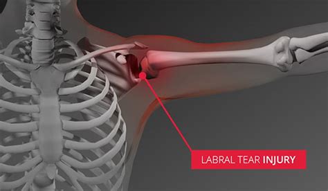 Labral Tear, SLAP Tear Shoulder Injuries - Sterling Medical Group