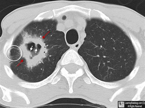 Squamous And Adenocarcinoma Lung Cancer