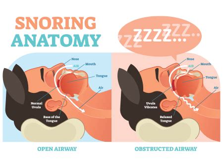 Snoring – Causes, Symptoms, Treatments, and Risk factors