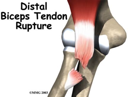 Distal Biceps Tear - General Components and Differential Diagnosis of ...