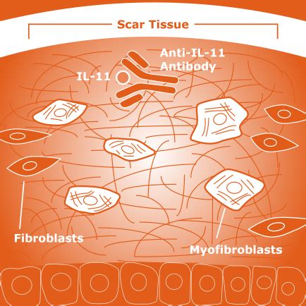 Interleukin-11, a New Therapeutic Target in IPF