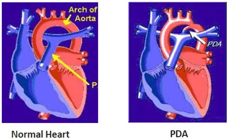 Patent Ductus Arteriosus (PDA) – Treatments | SingHealth