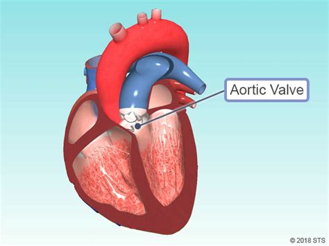 Aortic Valve Disease | The Patient Guide to Heart, Lung, and Esophageal ...