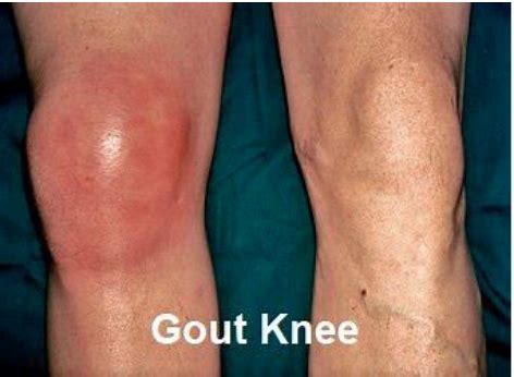 Gout Awareness – AAKP