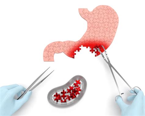 Final Stages Of Stomach Cancer What To Expect - CancerWalls