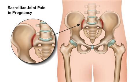 Can Pregnancy Cause Sacroiliac Joint Pain - Infoupdate.org