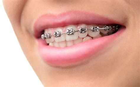 The Best Vs The Most Affordable Braces For Kids – mysmilesbraces