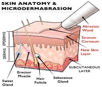 Microdermabrasion - Benefits and Side Effects