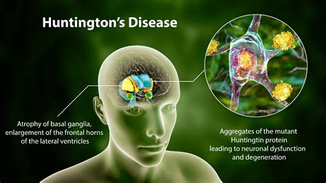 Huntington's Disease | Huntington Bed | Cocoon Bed | News | Berwick Care