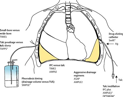 what is a malignant pleural effusion - Nikia Gruber