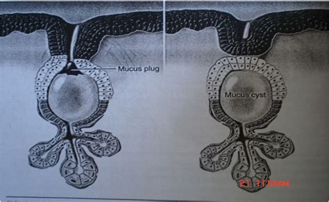 mucous retention cyst lip - pictures, photos