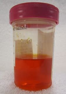 Blood Mix in the Urine Treatment, Symptoms and Cause - Healthy Life and ...