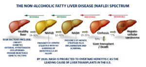 Fatty Liver Disease - Texas Liver Institute