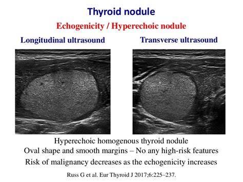 Types Of Thyroid Nodules Ultrasound