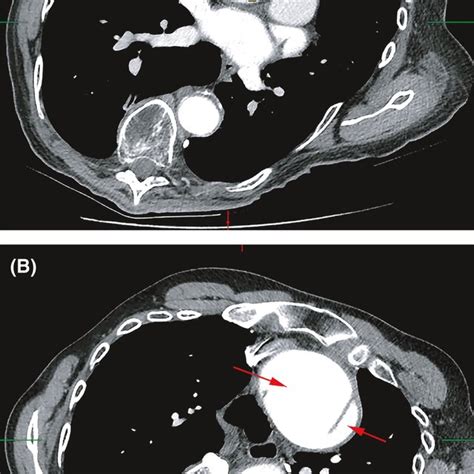 Chest CTA with contrast showing preoperative acute DeBakey type I... | Download Scientific Diagram