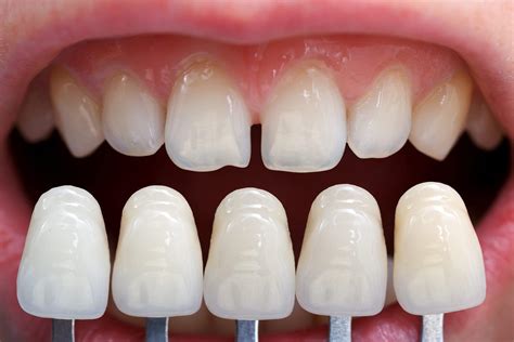 The Complete Guide To Getting Veneers [Updated For 2022] | Denture Smile Teeth Customizable ...