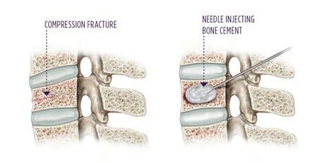 Vertebroplasty | Kyphoplasty | Summit Orthopedics