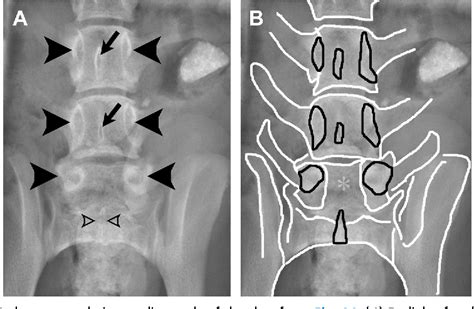 Figure 15 from Spina Bifida, Meningomyelocele, and Meningocele ...