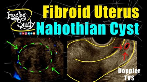 Fibroid Uterus with Nabothian Cyst || TVS || Doppler || Ultrasound || Case 249 - YouTube